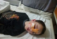 Маленькому жителю Звенигородки, якого покусав домашній пес конче необхідна наша допомога
